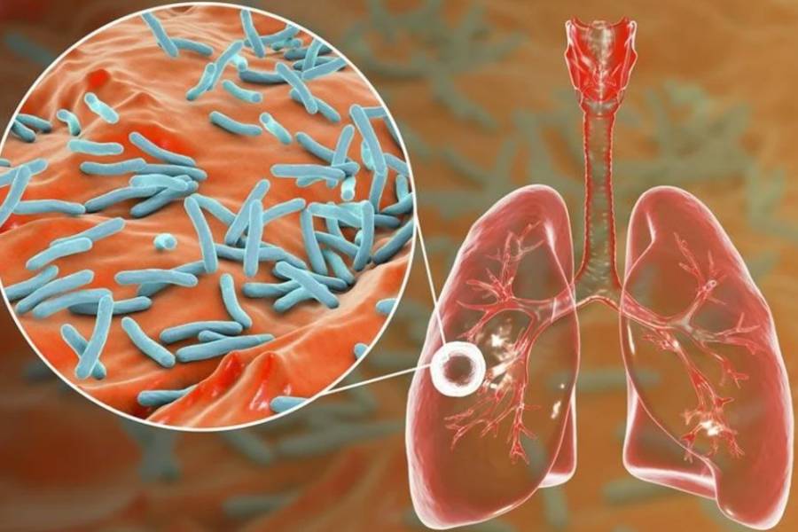 Alerta tuberculosis: se notificaron más de 13.000 casos en Argentina