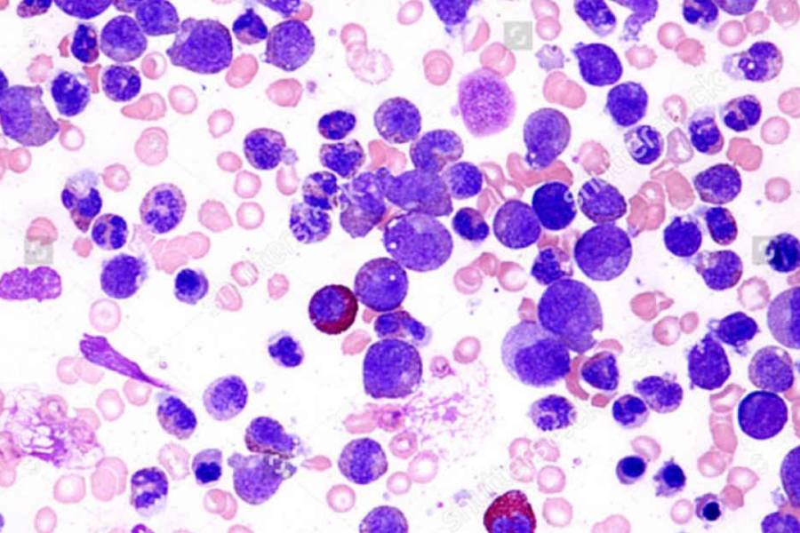 Cambió el paradigma de tratamiento de la leucemia y logran resultados inéditos